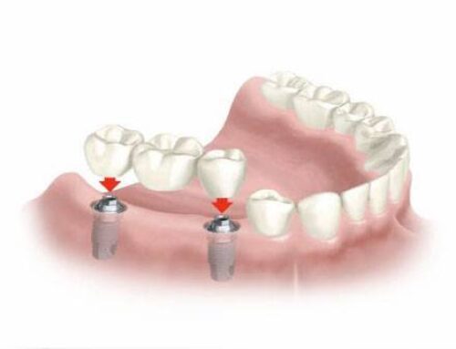 Protocolo de Implantes dentários